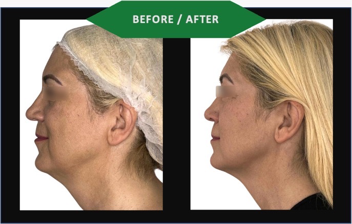 Avant et après les résultats de l'application de la technologie Attiva sur la peau d'une femme. Techniques et technologies de médecine esthétique et d'injections sous-cutanées.